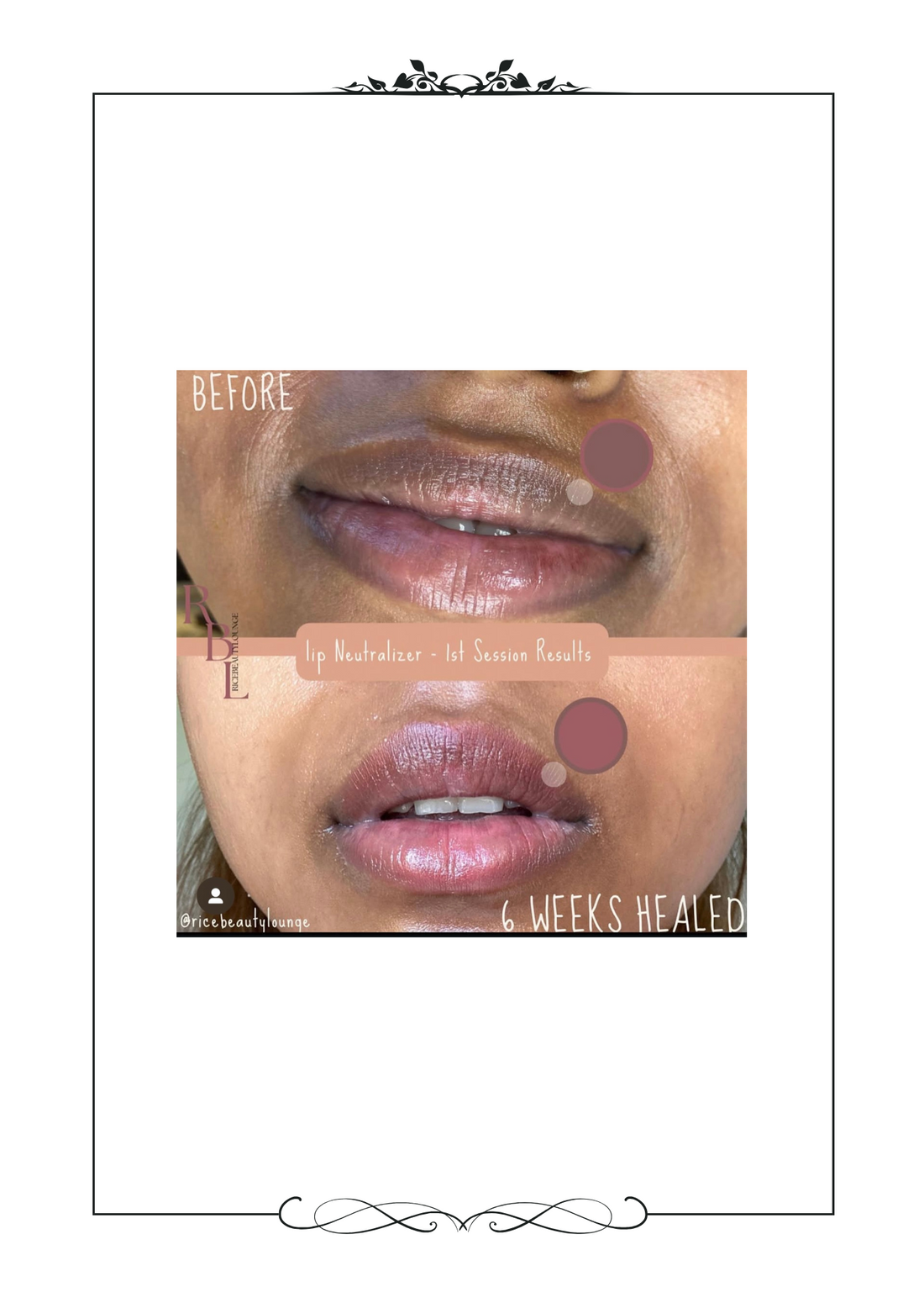 Dark Lip Neutralizer Before vs After