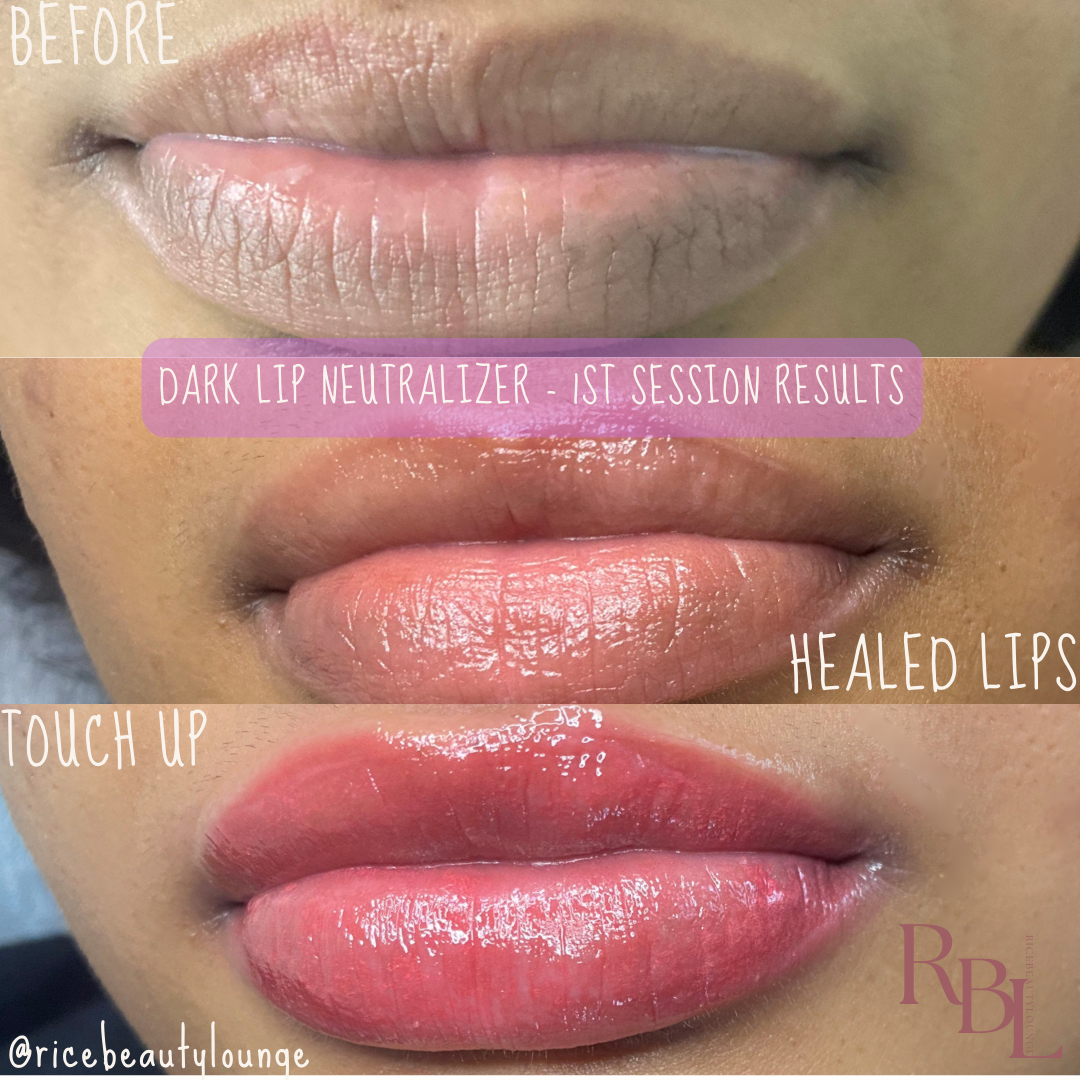 Dark Lip Neutralization 2 Session Package
