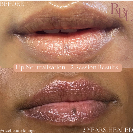 Dark Lip Neutralization 3 Session Package